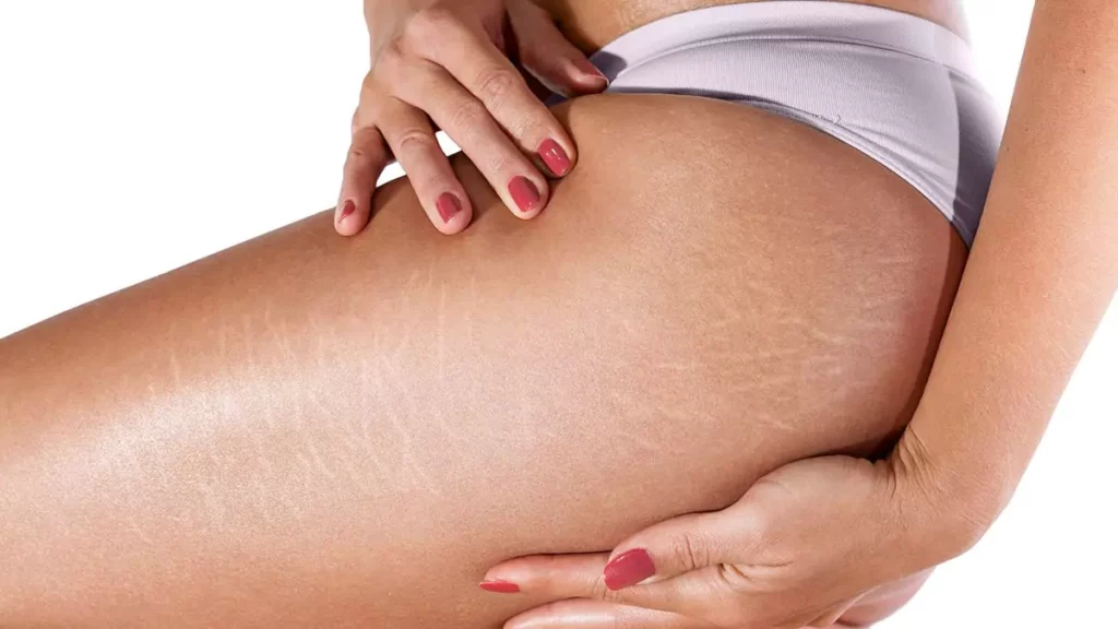 Mulher aplicando creme para estrias na perna