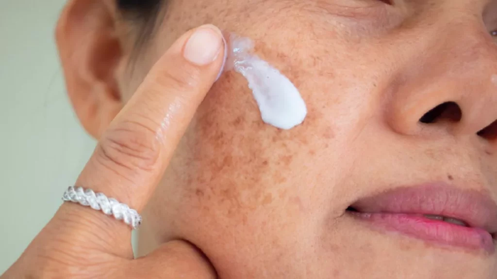 Mulher passando creme clareador em cima de manchas de melasma no rosto